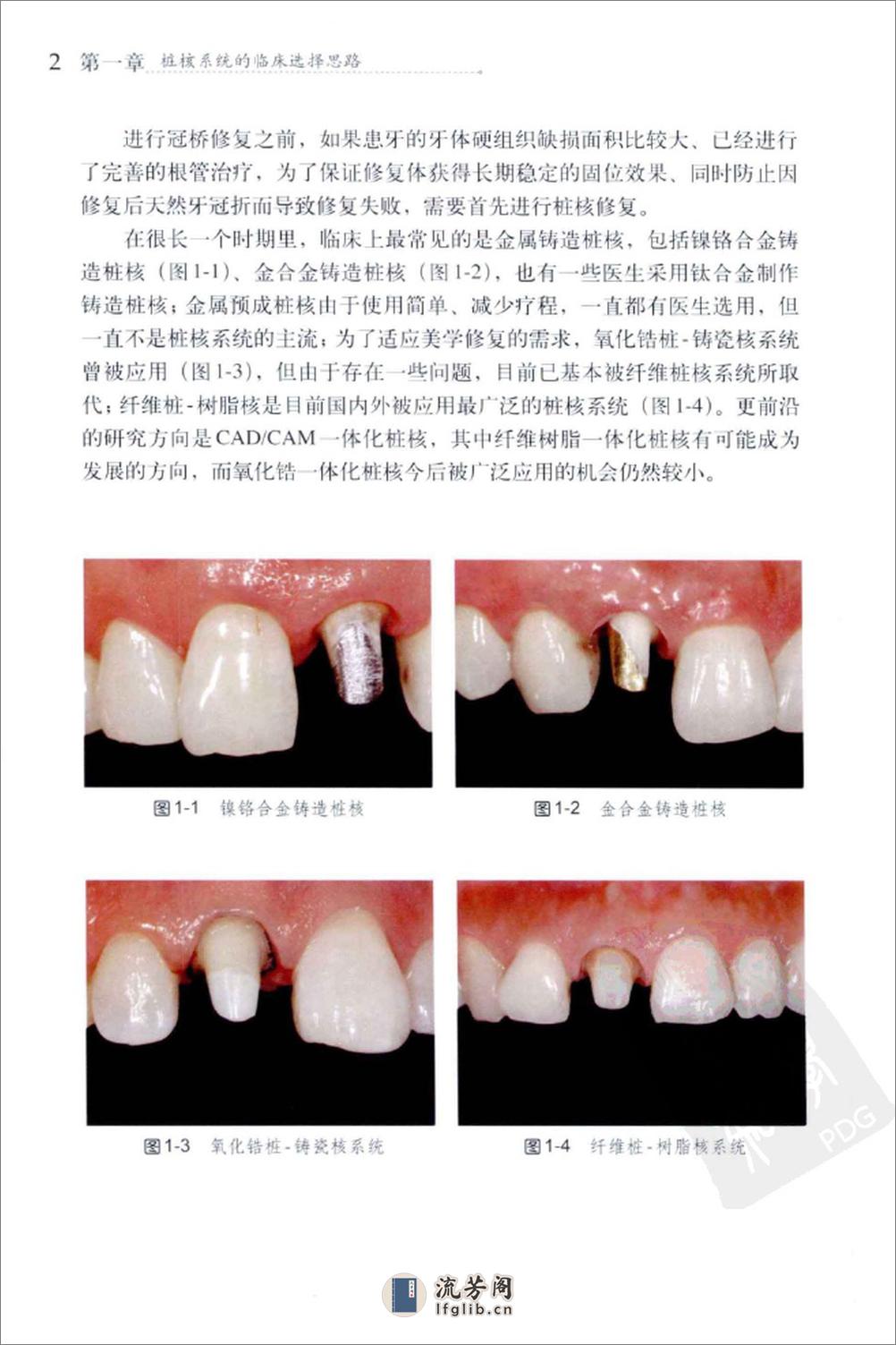 纤维桩修复技术_13192342 - 第12页预览图