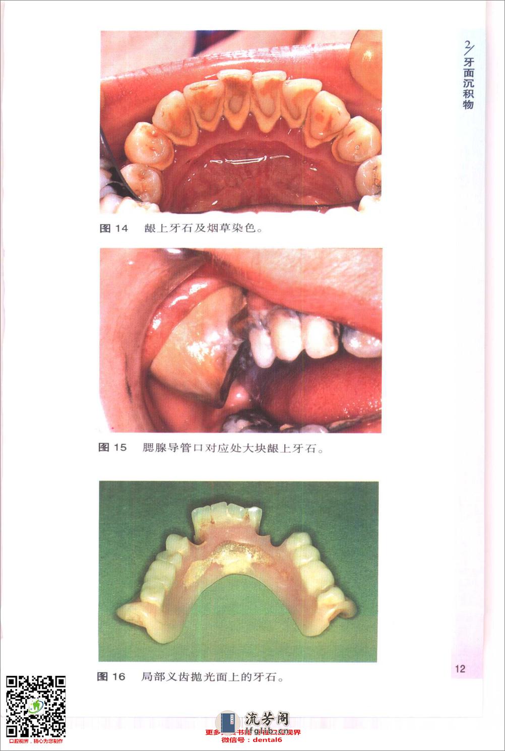 袖珍诊疗彩色图谱系列 牙周病学[英]希斯曼（Heasman，P.）等编著 - 第14页预览图