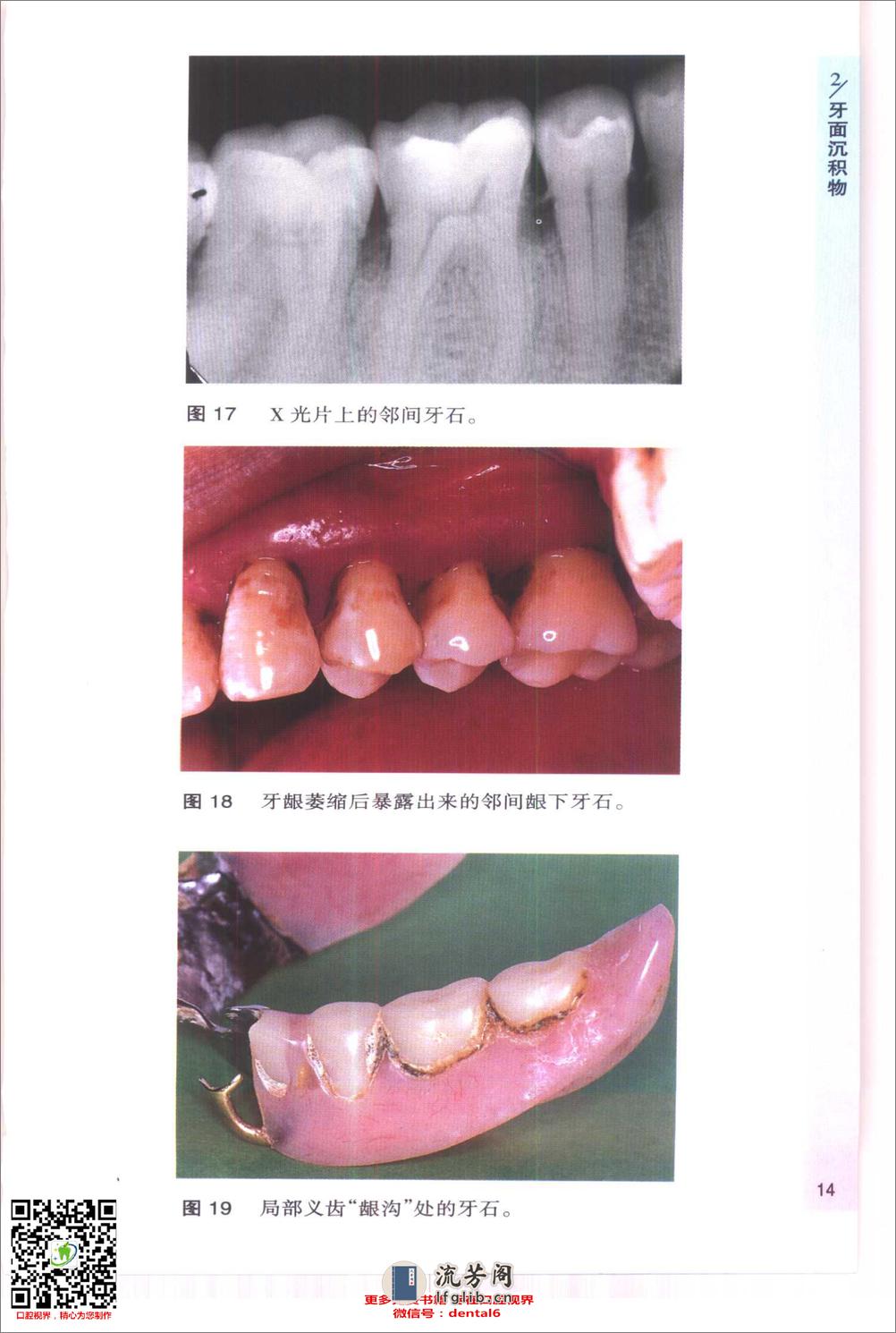 袖珍诊疗彩色图谱系列 牙周病学[英]希斯曼（Heasman，P.）等编著 - 第16页预览图