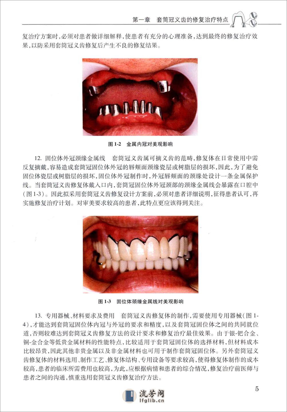 套筒冠义齿 - 第13页预览图