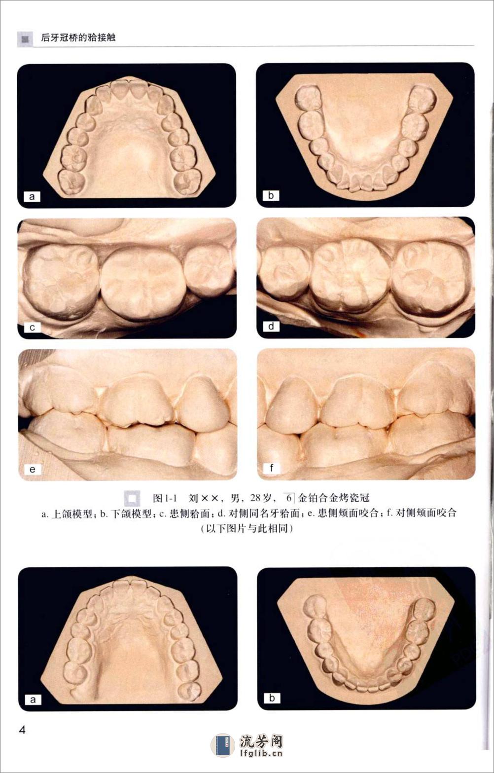 后牙冠桥的合接触_徐军2010（彩图） - 第13页预览图