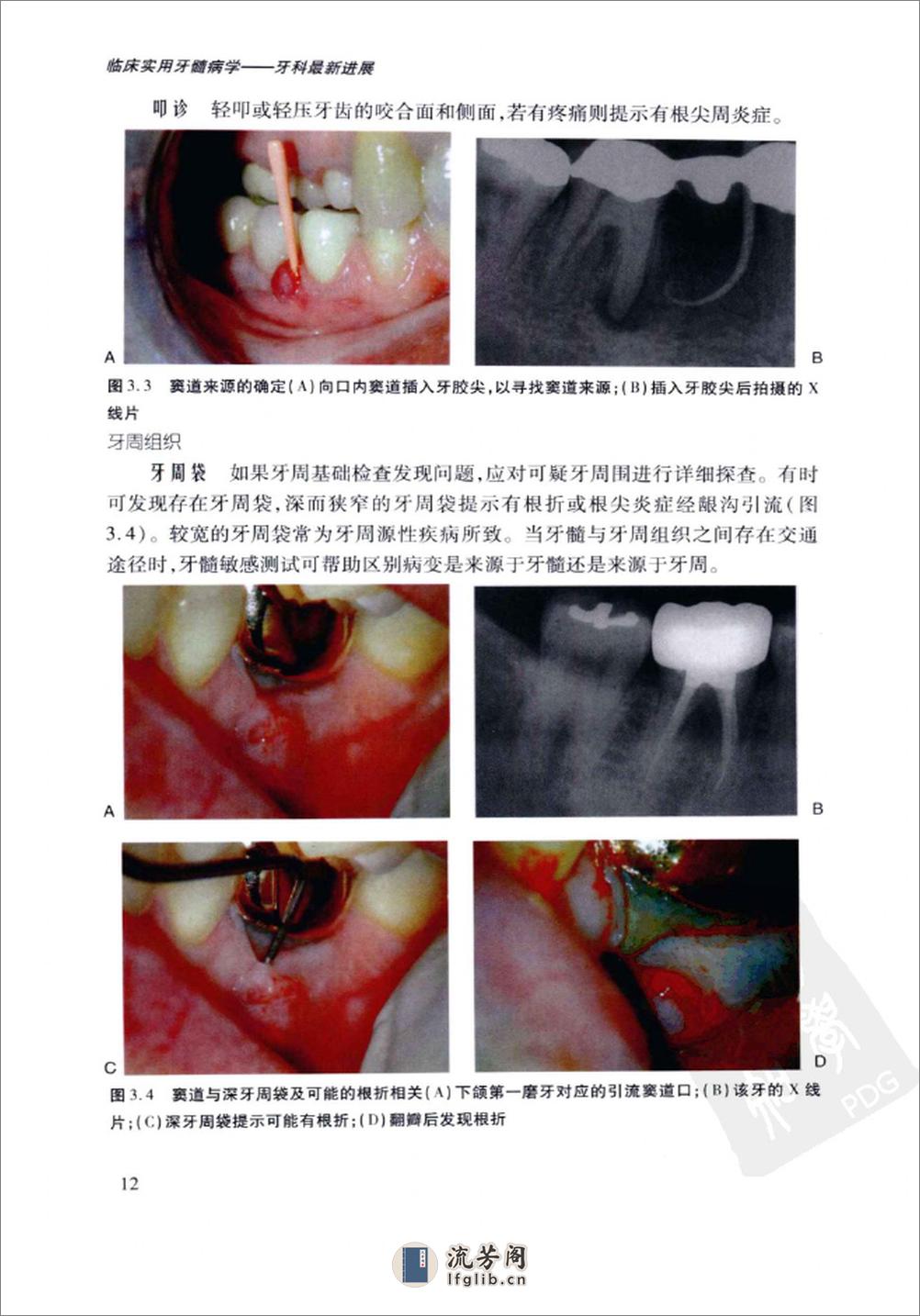 临床实用牙髓病学++牙科最新进展_12773659_... - 第20页预览图