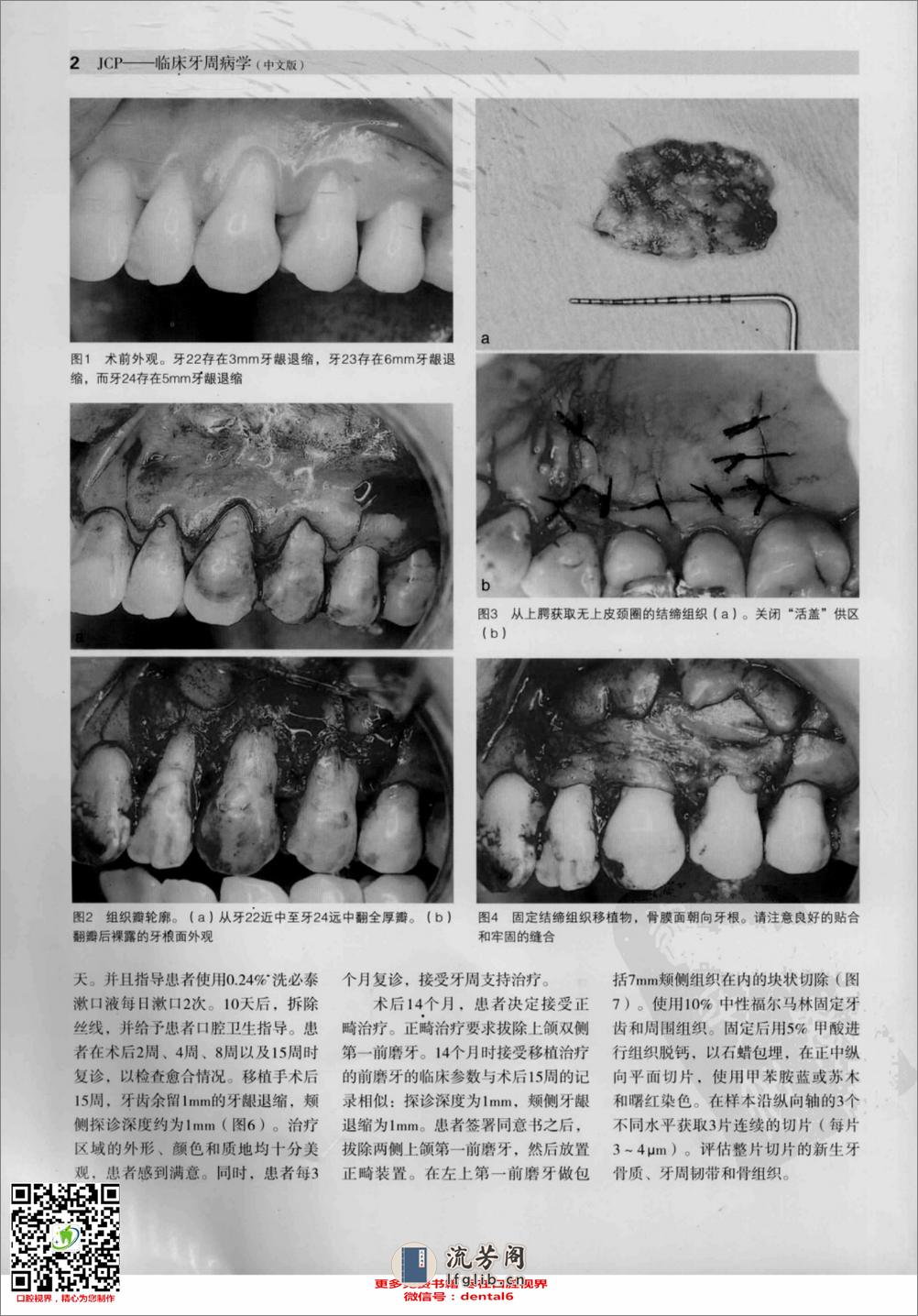 临床牙周病学  根面覆盖与牙周组织再生专辑  中文版_13284740_（意）托尼提主编 - 第5页预览图