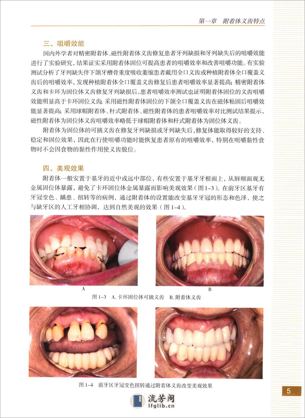 附着体义齿 - 第13页预览图