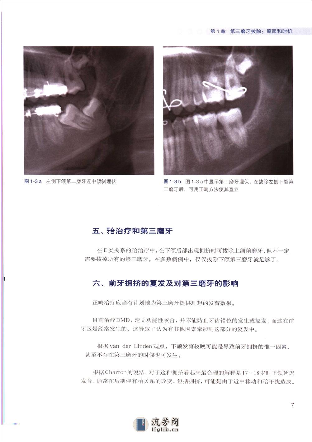 阻生第三磨牙拔除临床指南 - 第14页预览图