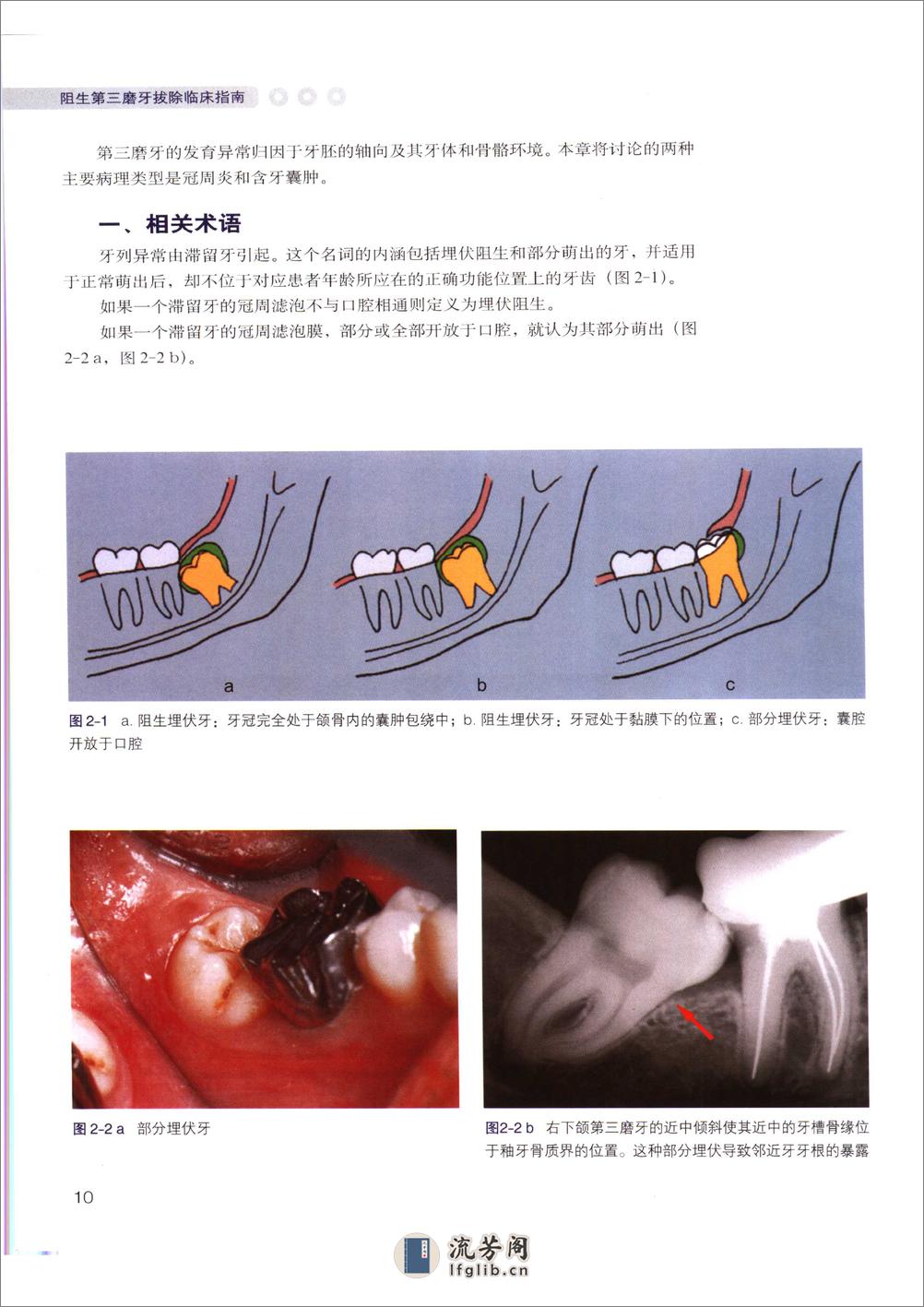 阻生第三磨牙拔除临床指南 - 第17页预览图