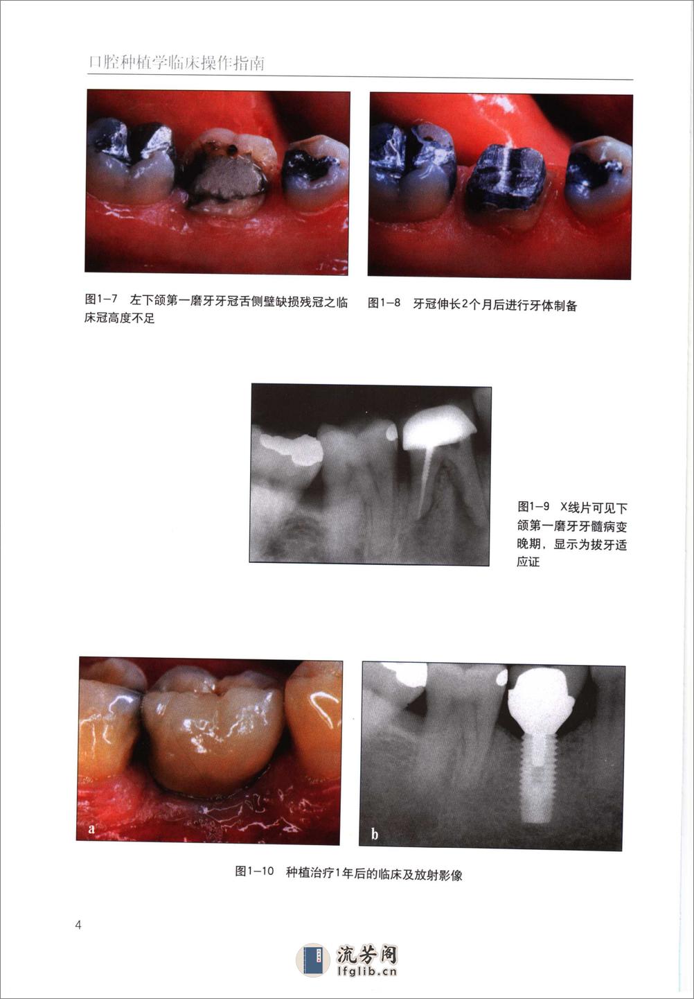 国际牙科名著系列—口腔种植学临床操作指南 - 第13页预览图