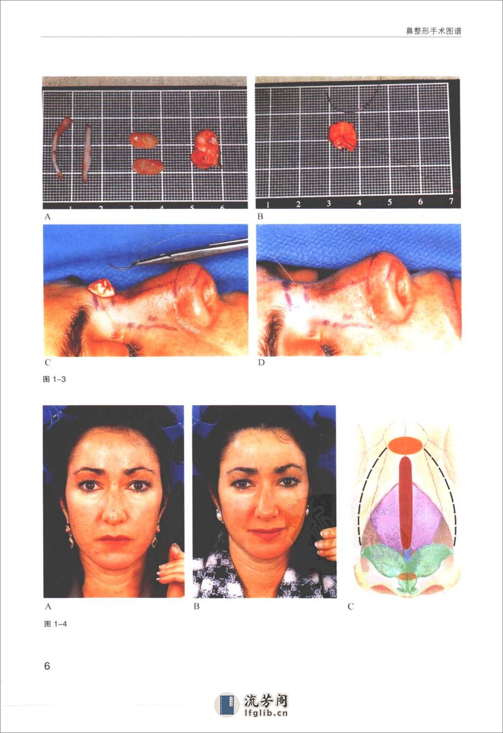 鼻整形手术图谱 - 第14页预览图