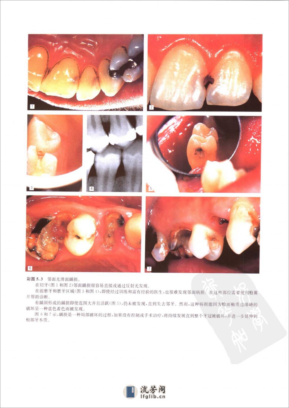 龋病学：疾病及其临床处理 - 第15页预览图