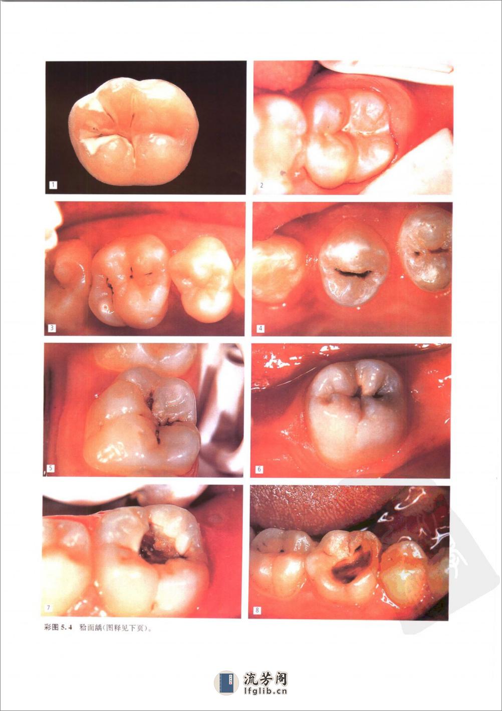 龋病学：疾病及其临床处理 - 第16页预览图