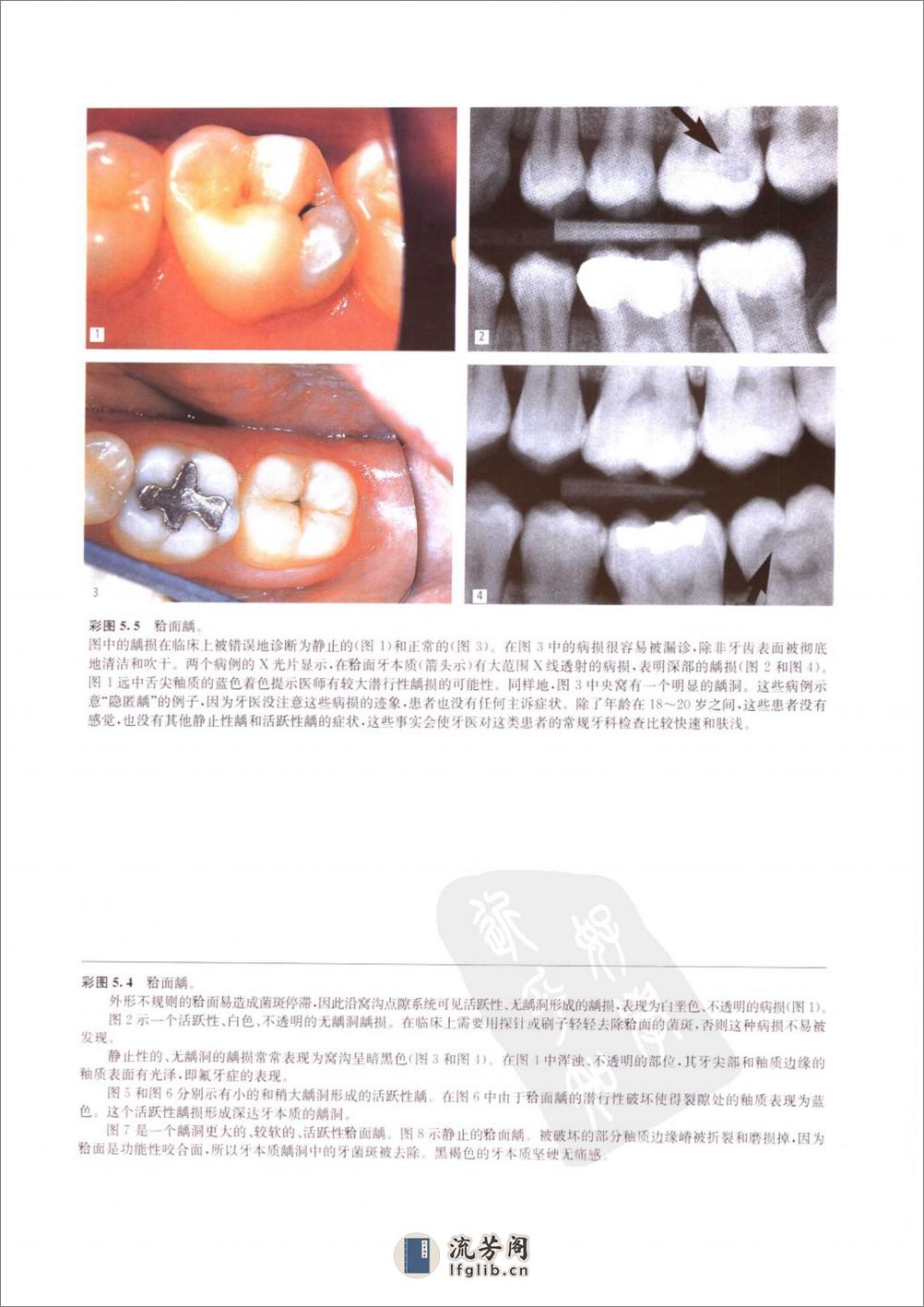 龋病学：疾病及其临床处理 - 第17页预览图