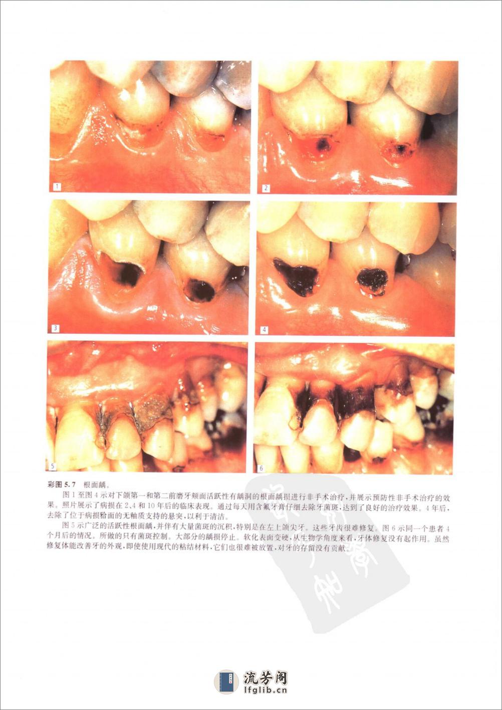 龋病学：疾病及其临床处理 - 第19页预览图