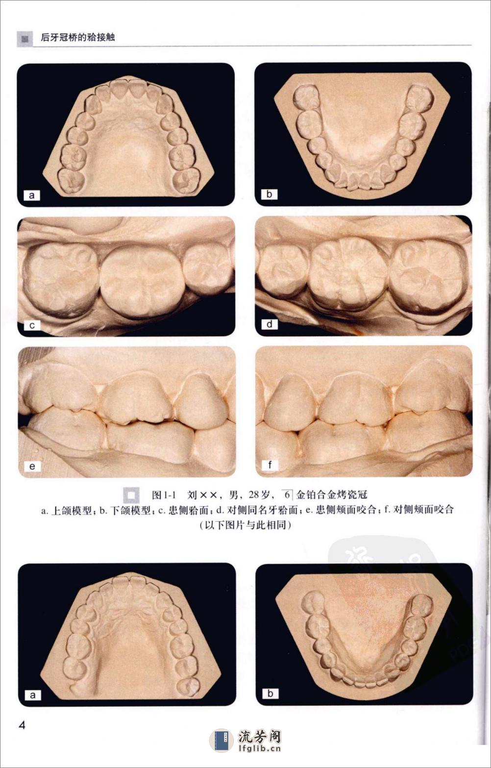 后牙冠桥的合接触_徐军2010（彩图） - 第13页预览图