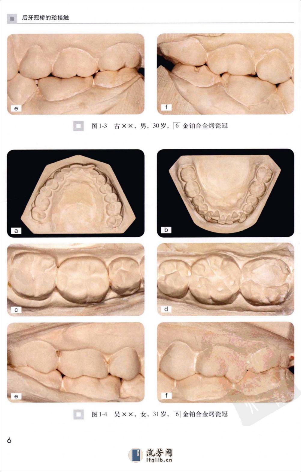 后牙冠桥的合接触_徐军2010（彩图） - 第15页预览图