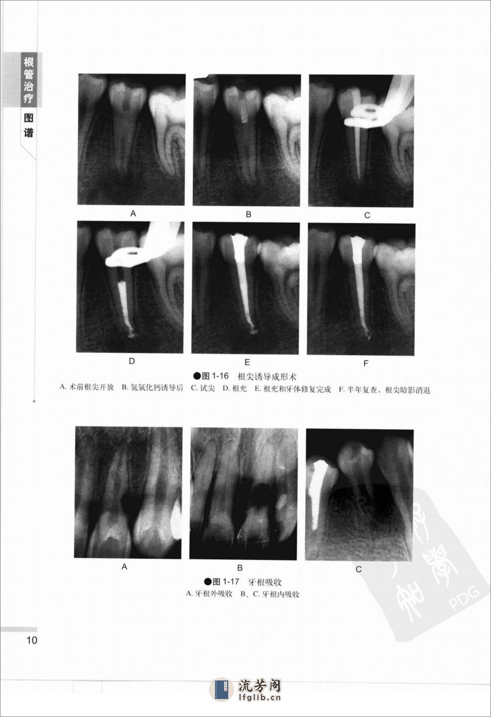 根管治疗图谱 - 第17页预览图