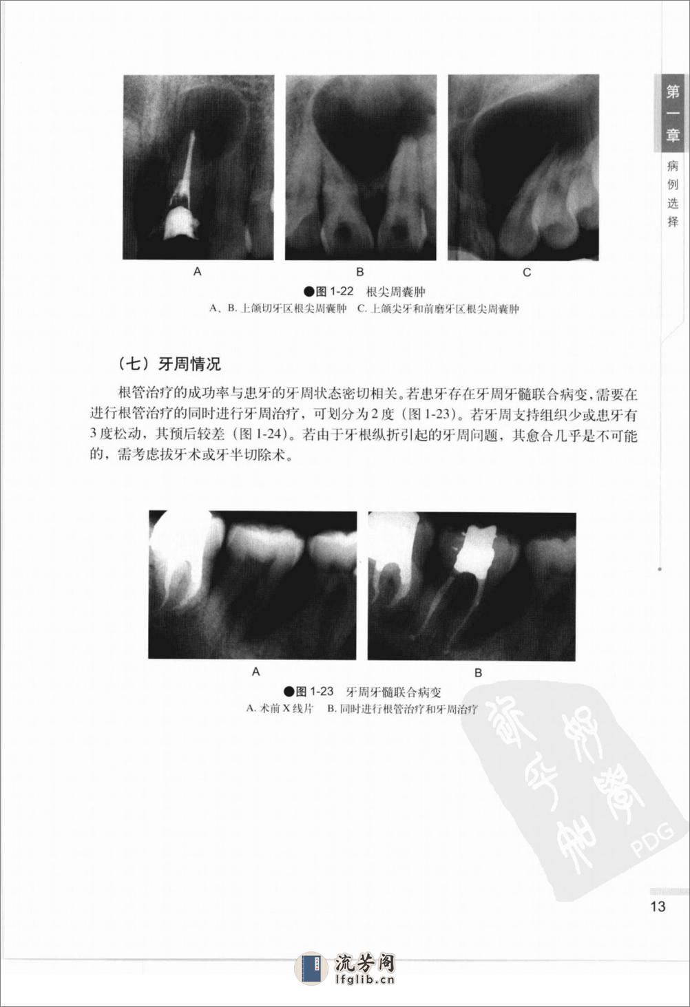 根管治疗图谱 - 第20页预览图