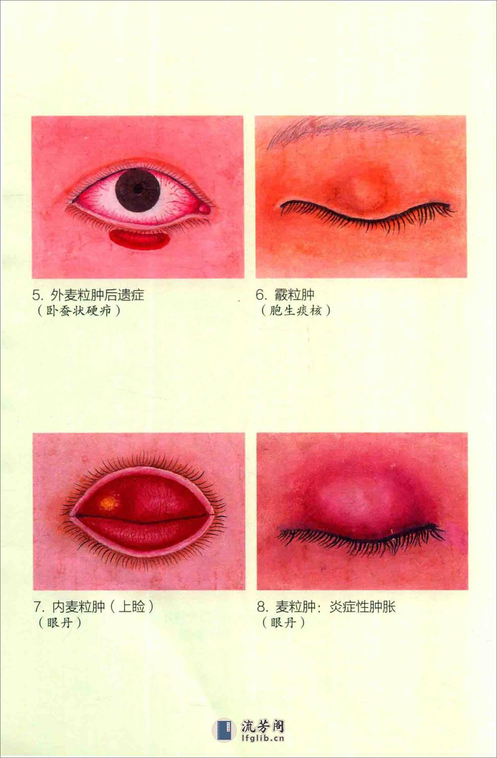 眼病治疗绝招 王霖有 _978-7-5132-4379-7 - 第6页预览图