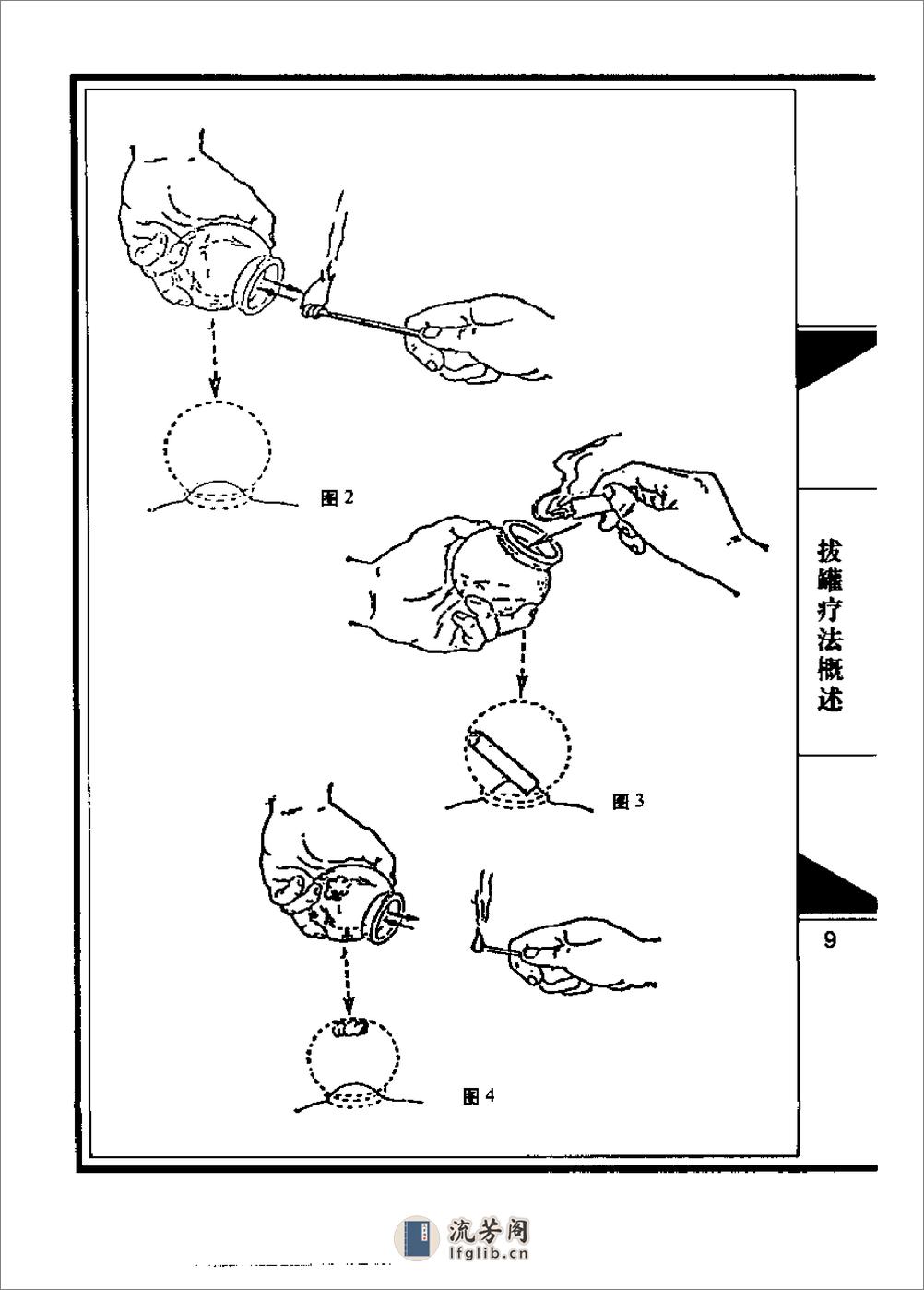 拔罐疗法（罗惠平） - 第15页预览图