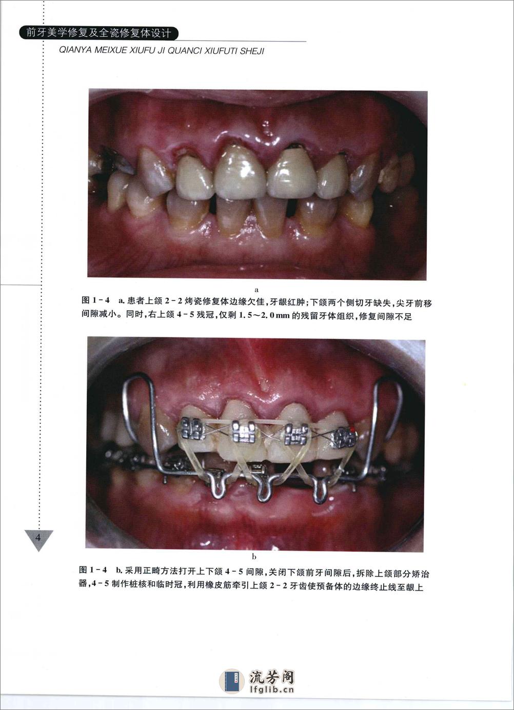 前牙美学修复及全瓷修复体设计 - 第12页预览图