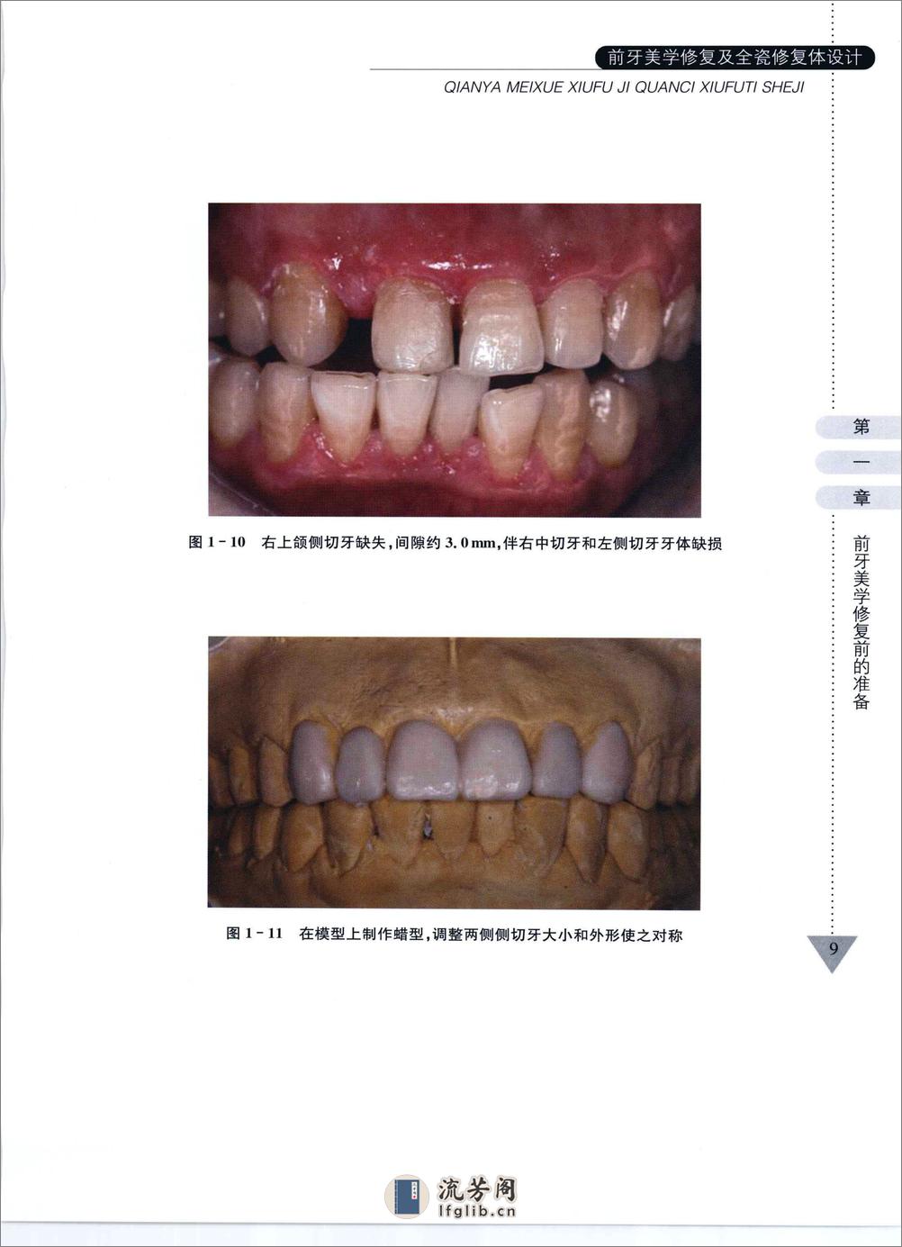 前牙美学修复及全瓷修复体设计 - 第17页预览图