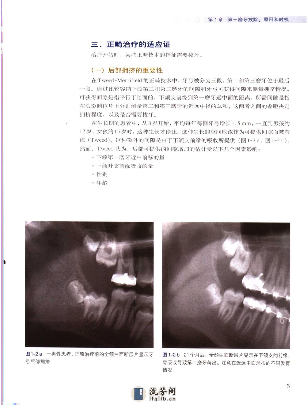 阻生第三磨牙拔除临床指南 - 第13页预览图