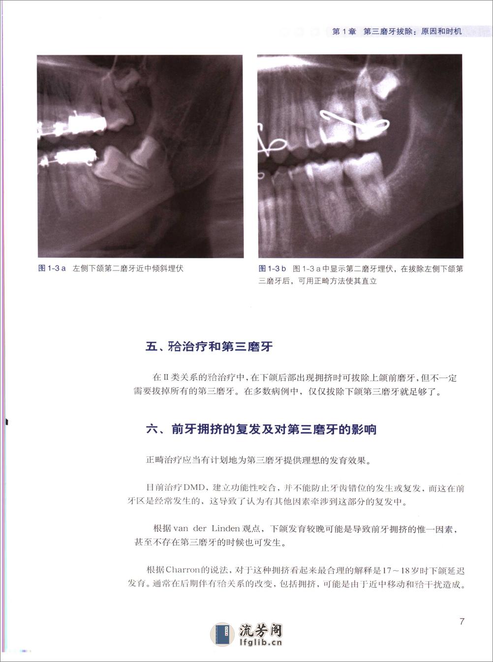 阻生第三磨牙拔除临床指南 - 第15页预览图