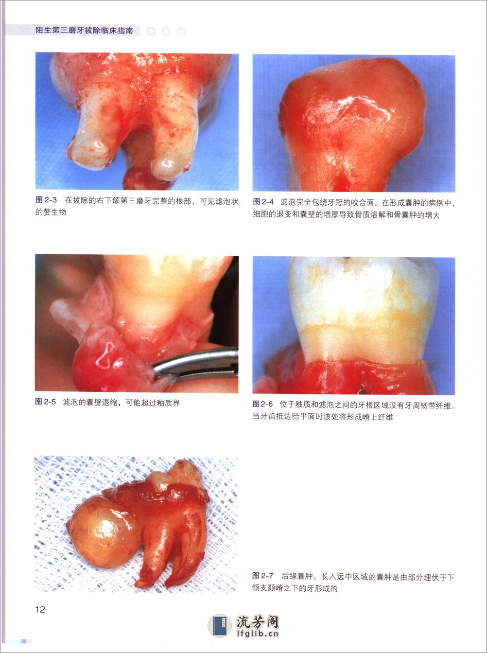 阻生第三磨牙拔除临床指南 - 第20页预览图