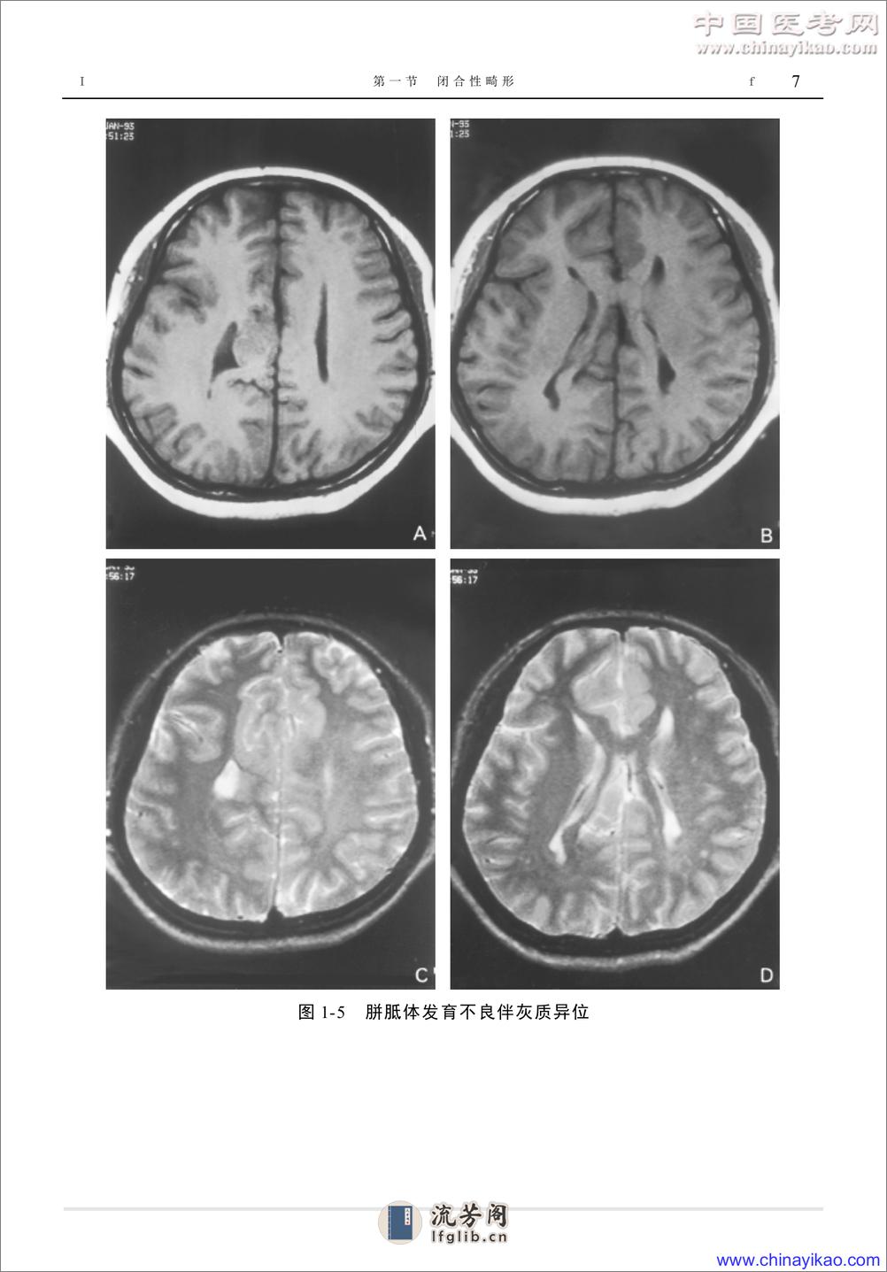 W-神经疾病影像学图鉴——武乐斌 柳 澄 王光彬-2002 - 第17页预览图