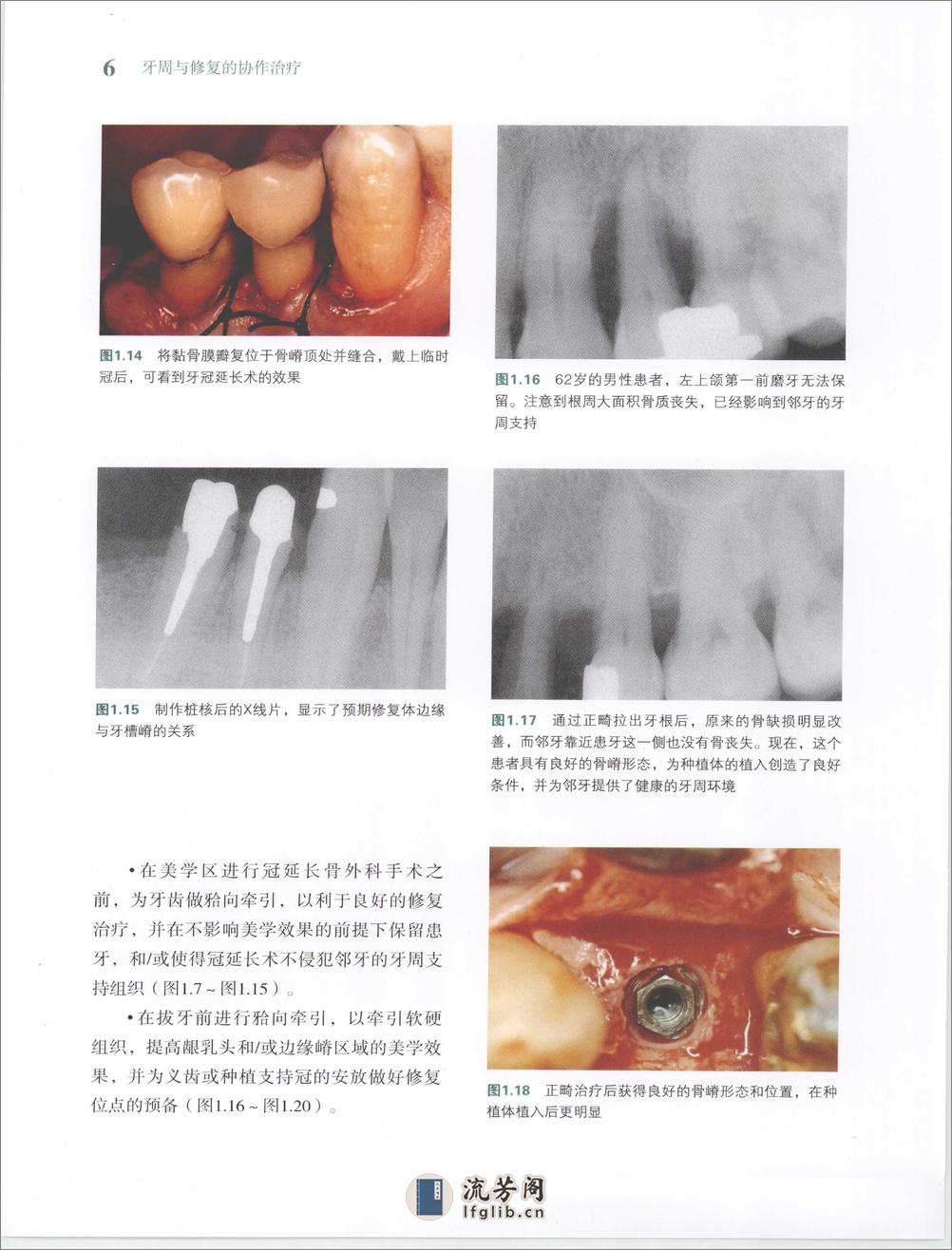 牙周与修复的协作治疗 - 第14页预览图