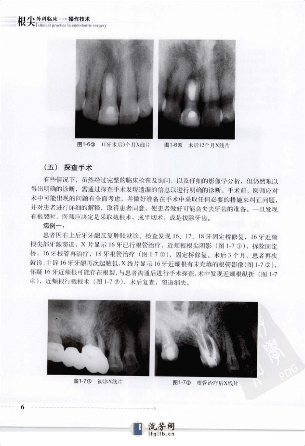 根尖外科临床操作技术_12625986 - 第14页预览图