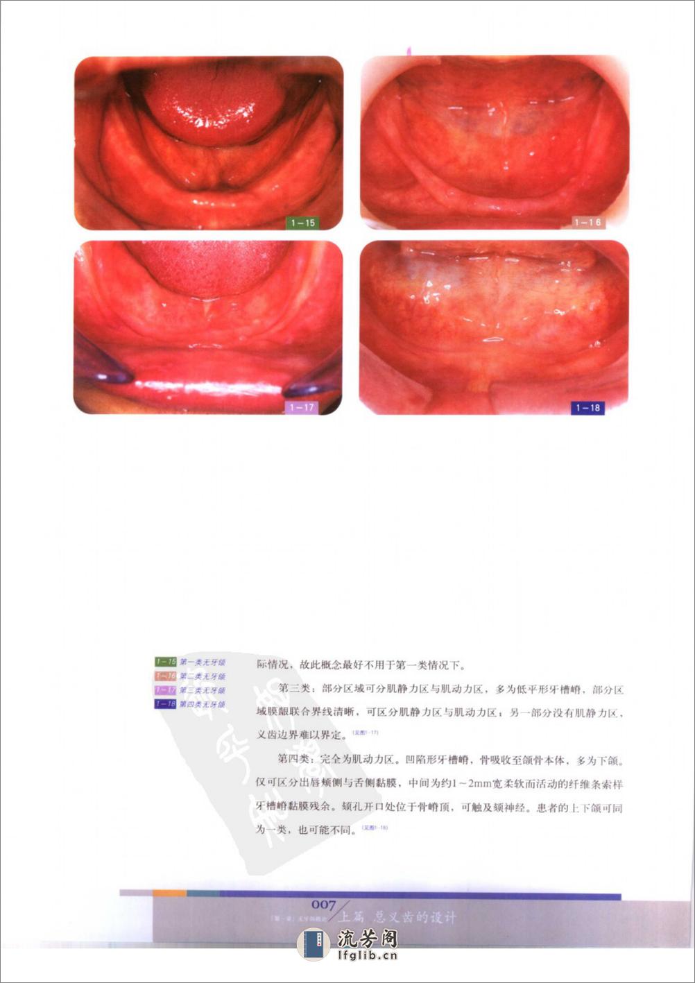 总义齿与可摘局部义齿的设计 - 第13页预览图
