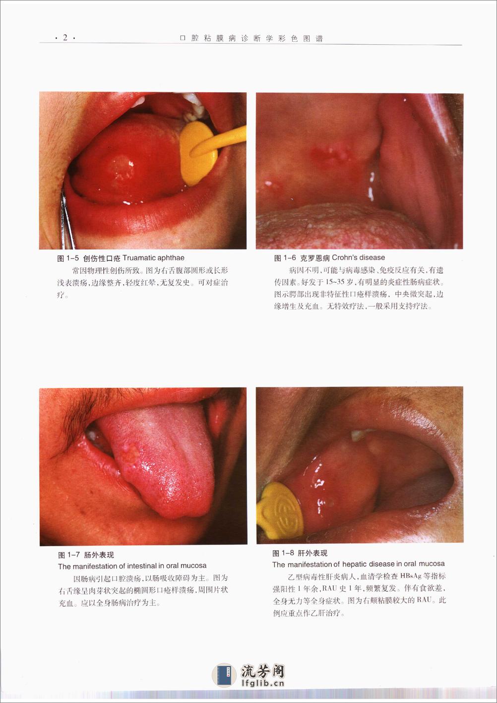 口腔粘膜病诊断学彩色图谱 - 第13页预览图
