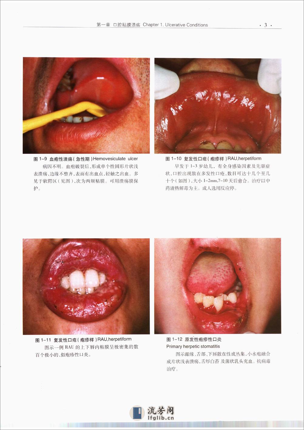 口腔粘膜病诊断学彩色图谱 - 第14页预览图