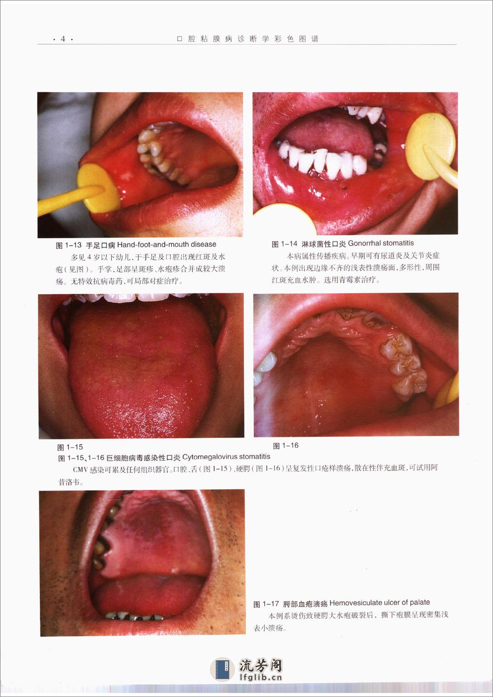 口腔粘膜病诊断学彩色图谱 - 第15页预览图