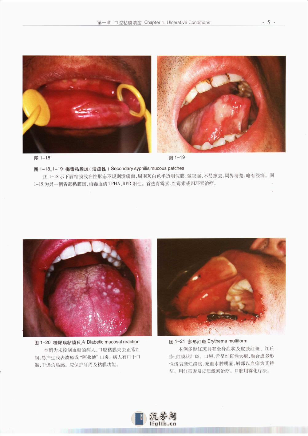 口腔粘膜病诊断学彩色图谱 - 第16页预览图