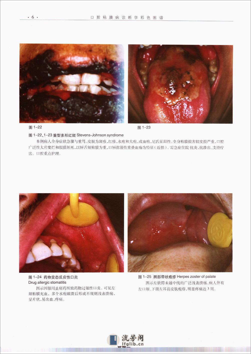 口腔粘膜病诊断学彩色图谱 - 第17页预览图